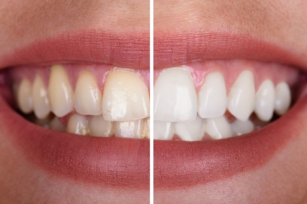 teeth-whitening-BA-Copy.jpg